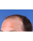Before Hair Transplant&nbsp;2 Sessions (Areas)